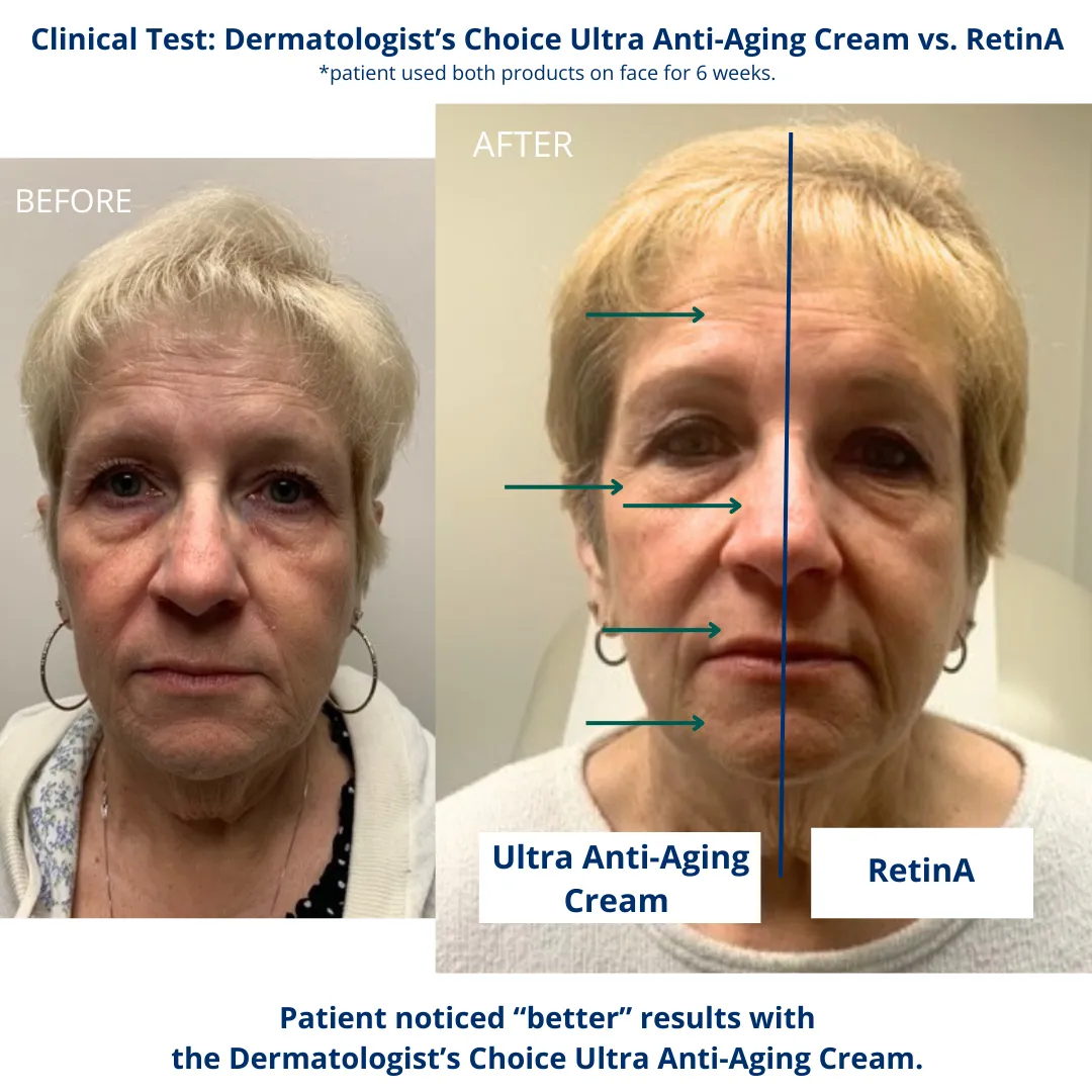 Ultra Anti-Aging Cream active potent non-neutralized glycolic acid (AHA)